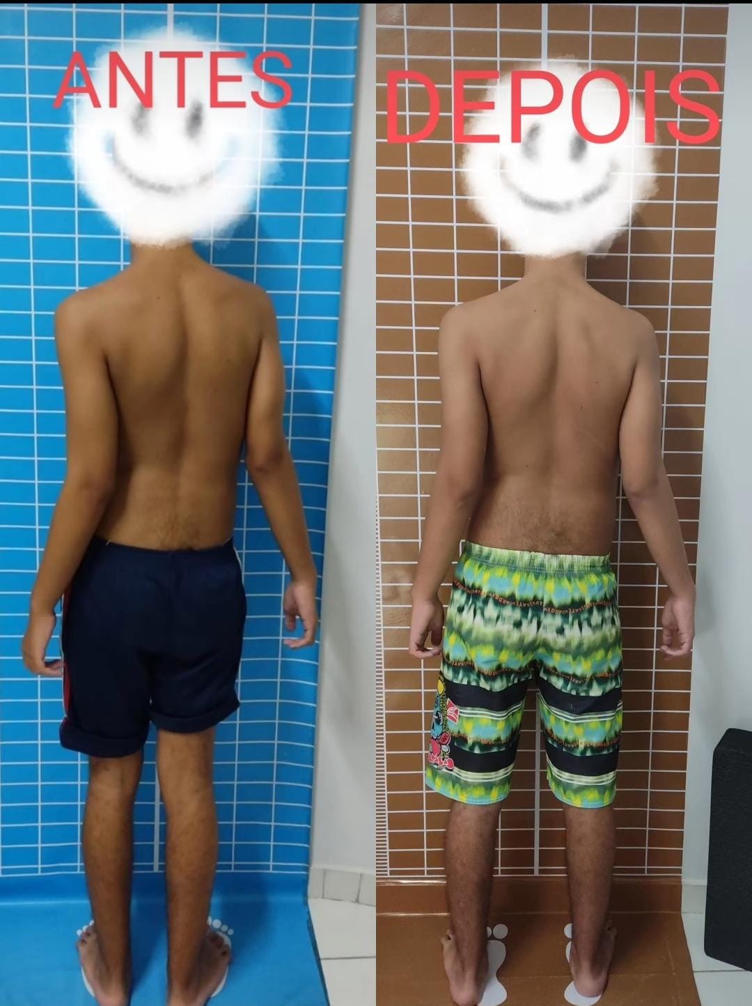 Tratamento de escoliose e correção postural.